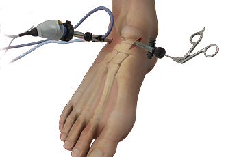Common Conditions That Could Require Arthroscopic Ankle Surgery