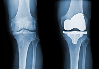 Everything You Need to Know about Total Knee Replacement (Arthroplasty)