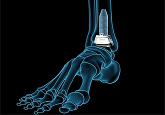 How a Total Ankle Replacement Fixes Arthritis in Your Ankle