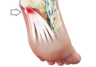 Plantar Fasciitis: Everything You Need to Know