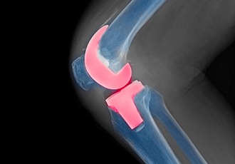 Total Joint Replacement Surgery