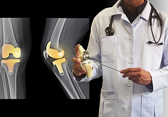 Total Joint Replacement: What You Should Know