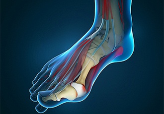 What To Do When You Have A Bunion