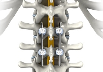 When is Spinal Fusion Surgery Recommended?