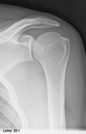 Figure 1. X-ray of a normal shoulder.