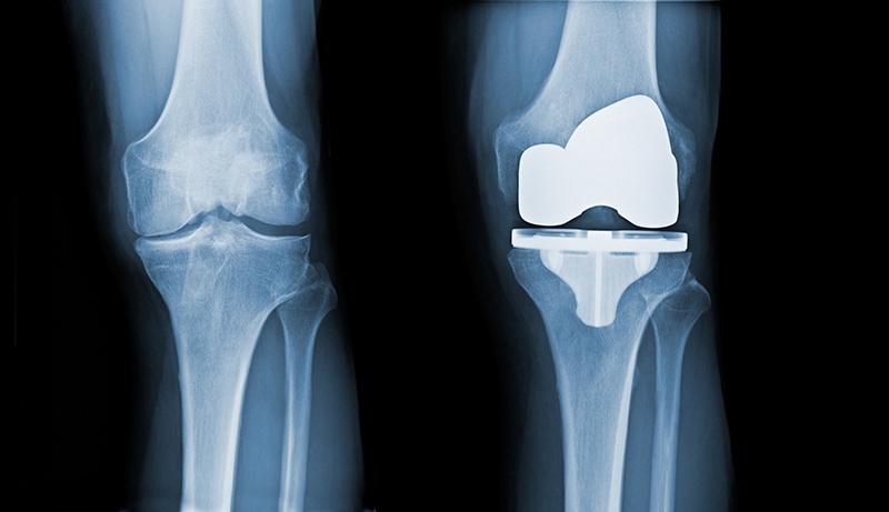 Everything You Need to Know about Total Knee Replacement (Arthroplasty)