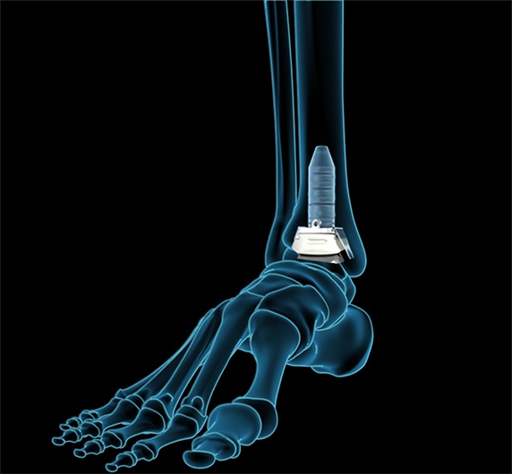 How a Total Ankle Replacement Fixes Arthritis in Your Ankle