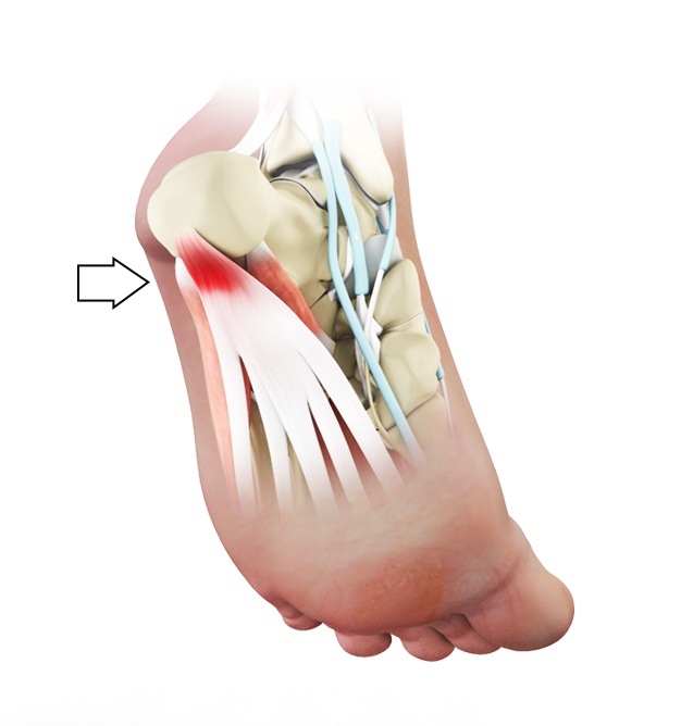 Plantar Fasciitis: Everything You Need to Know