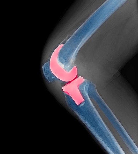 Total Joint Replacement Surgery