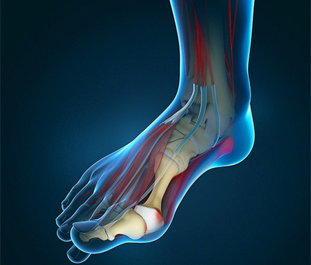 What To Do When You Have A Bunion