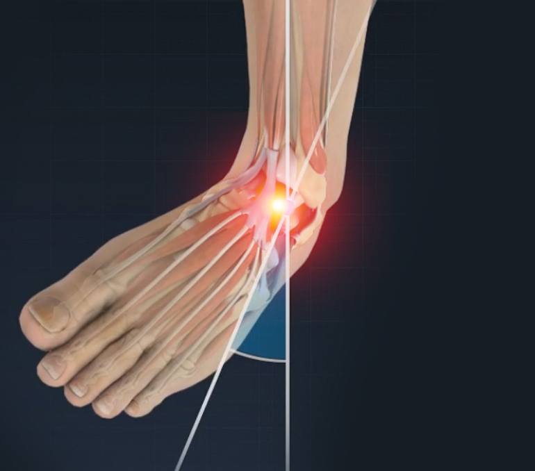 Ankle Sprains 101: Causes, Symptoms, Prevention, & Treatment